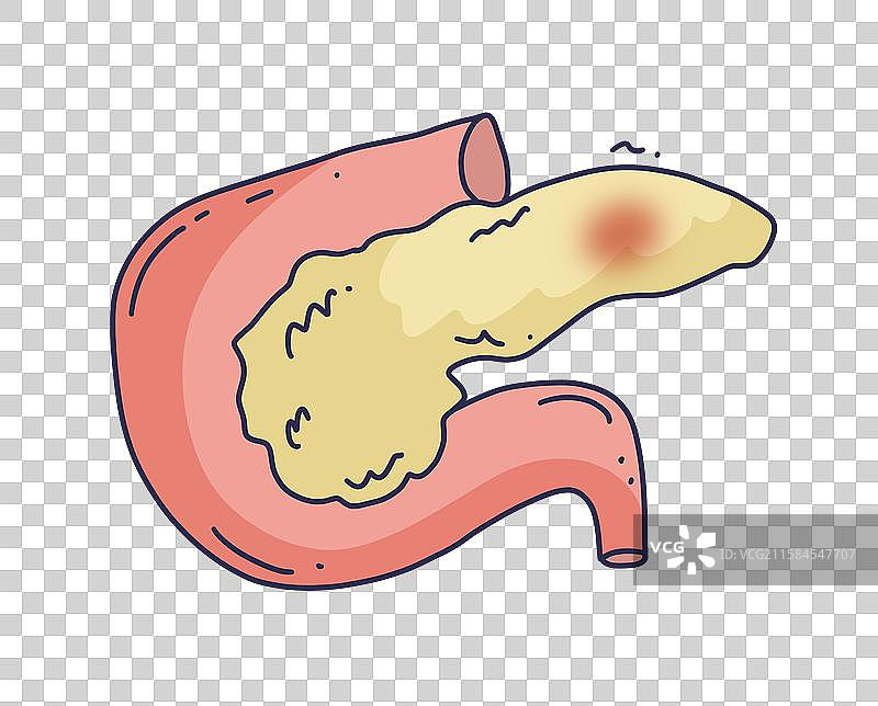 胰腺炎，胰腺癌图片素材