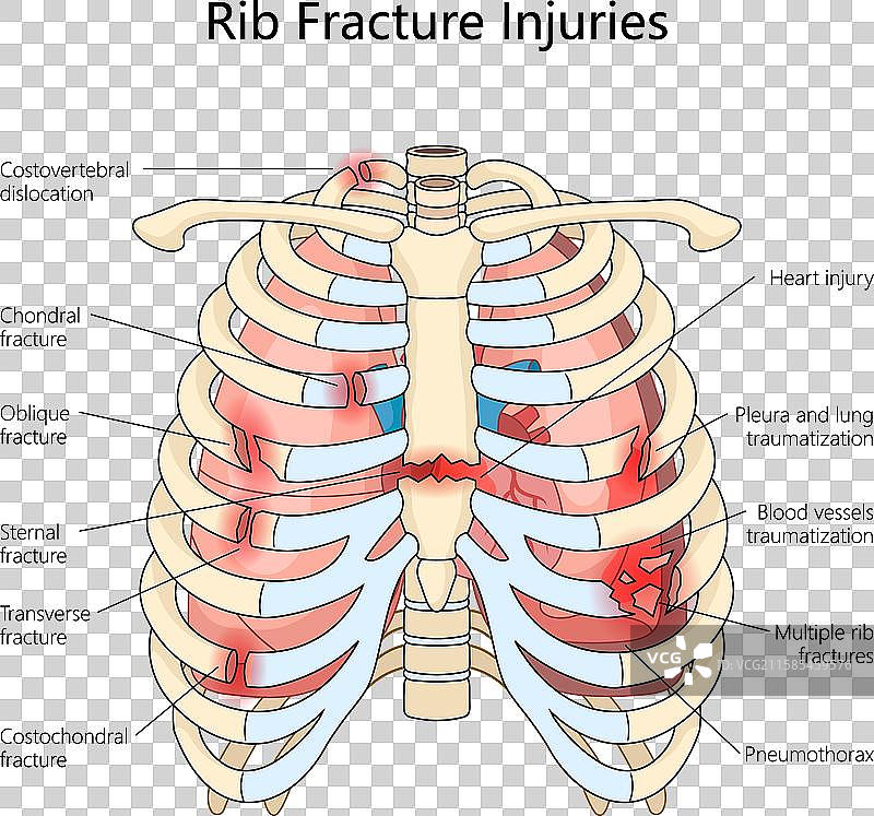 各种肋骨骨折伤害图解 医学图片素材