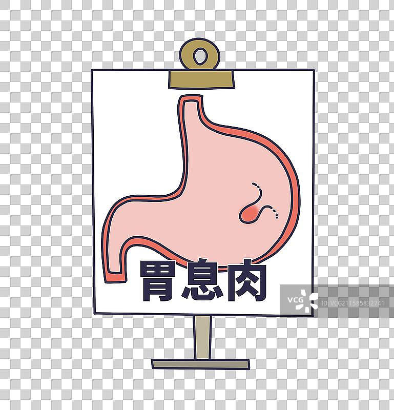 胃息肉，胃部消化系统疾病图片素材