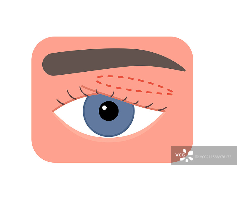 切线眼睑矫正图片素材