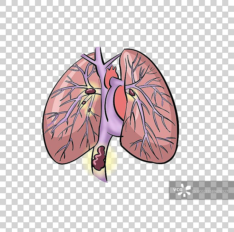 肺栓塞的肺结构图图片素材