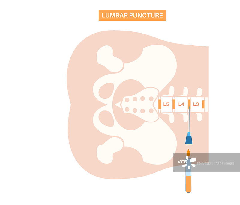 腰椎穿刺图片素材