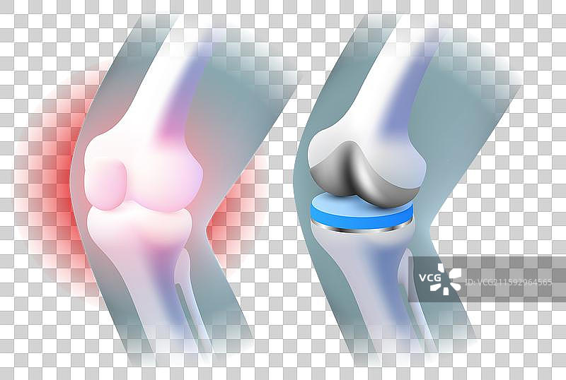 膝关节植入物的腿部X光三维可视化图片素材