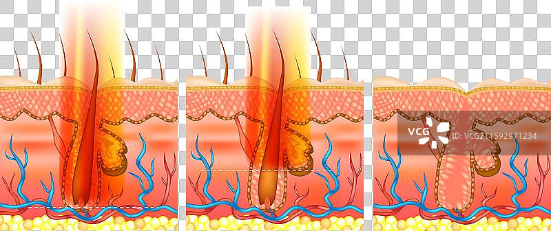 激光脱毛的穿透深度图片素材