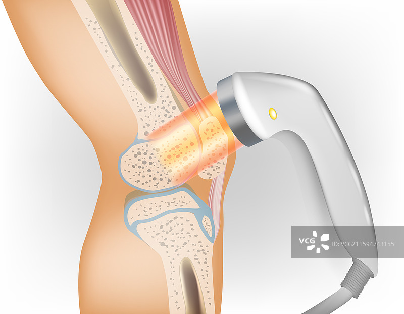 医疗激光疗法 激光疗法在图片素材