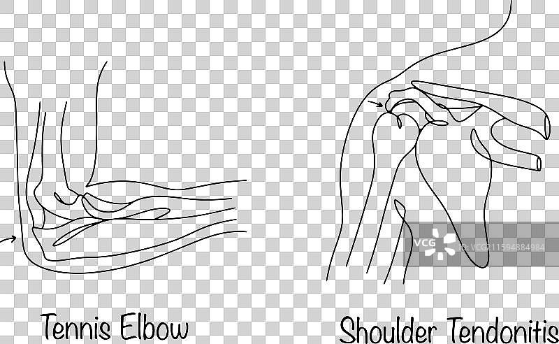 肌腱炎图片素材