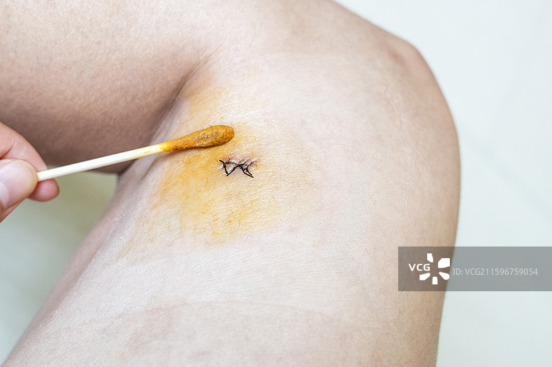 给术后缝合伤口消毒换药图片素材