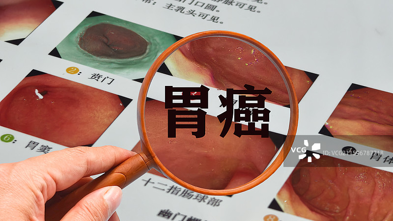 胃炎胃癌胃镜检查图片素材