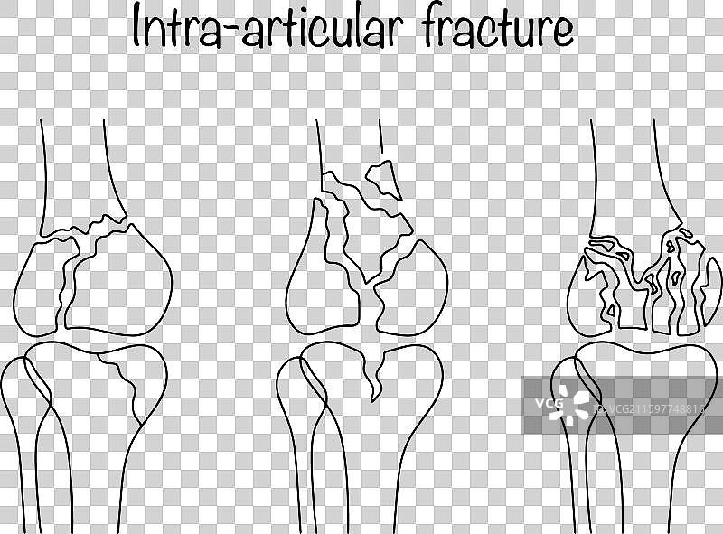 关节内骨折图片素材