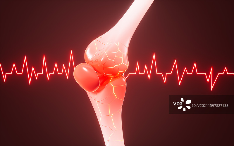 人类关节炎关节肿胀骨裂概念3D渲染图片素材