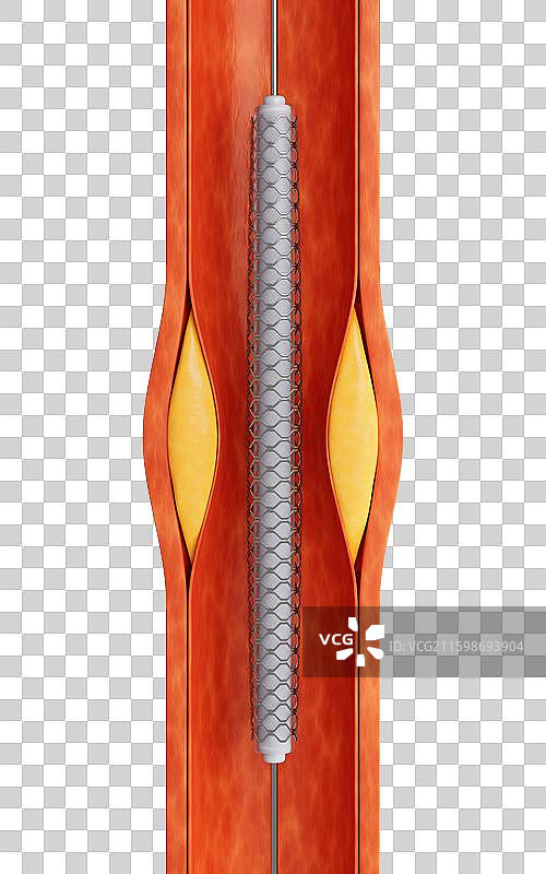 血管中的冠状动脉支架三维渲染图片素材