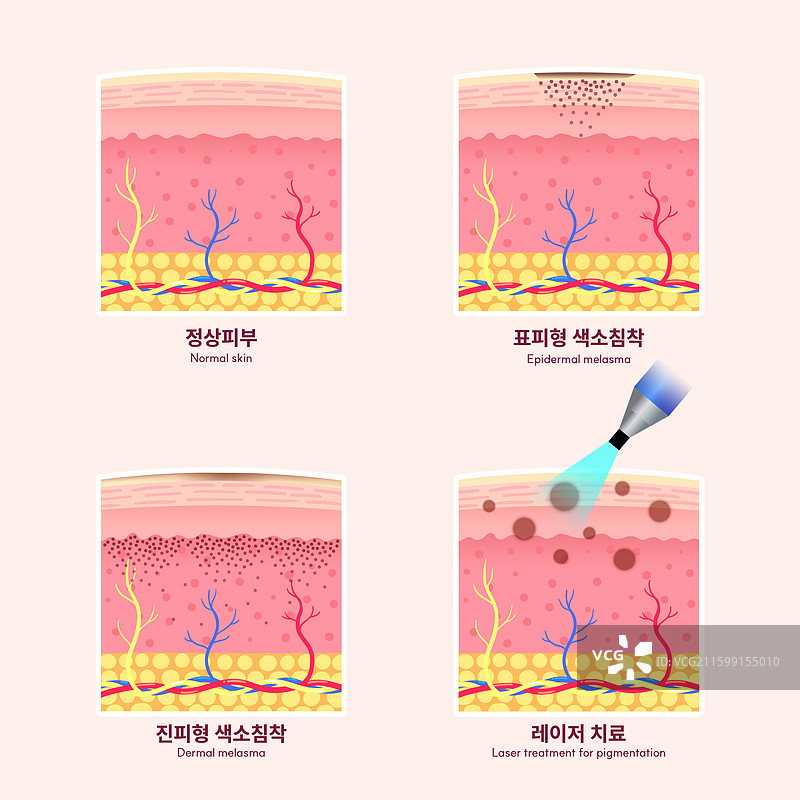 皮肤科，人类皮肤，真皮，医学，内脏器官，色素沉着，解剖学，激光，雀斑图片素材