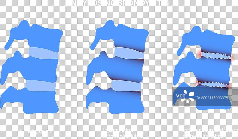 强直性脊柱炎图片素材