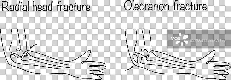 手臂骨折图片素材