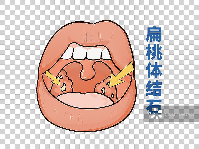 嘴里长了扁桃体结石图片素材