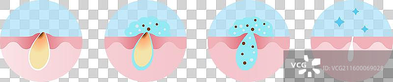 痤疮粉刺治疗过程图标集图片素材