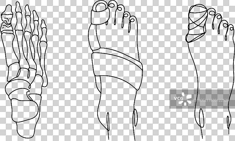 骨折的脚趾图片素材