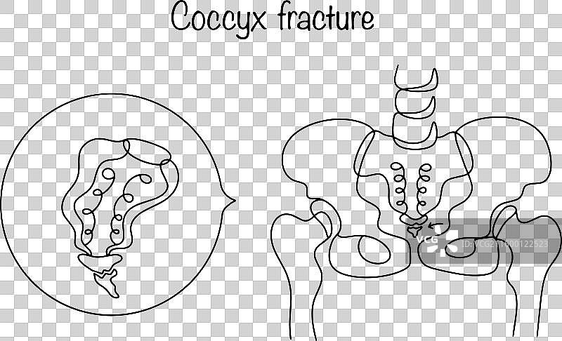尾骨骨折图片素材