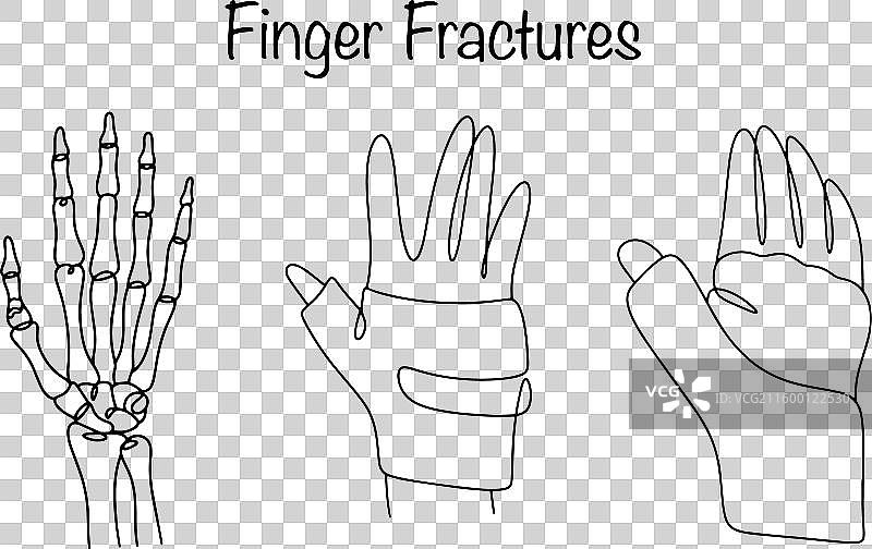 手指骨折图片素材