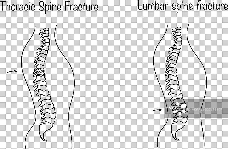 脊柱骨折的类型图片素材