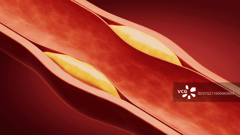 血管中的冠状动脉支架三维渲染图片素材