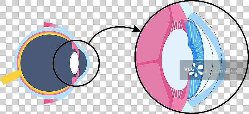 白内障眼疾图片素材