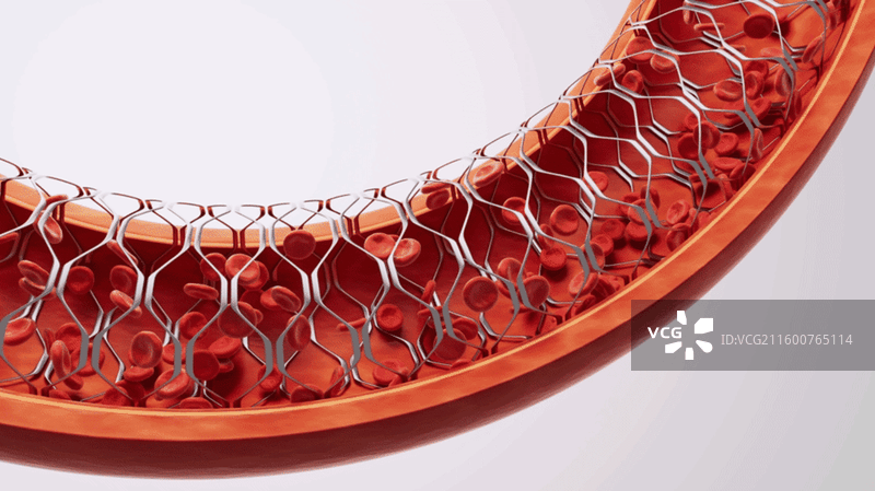 血管中的冠状动脉支架三维渲染图片素材