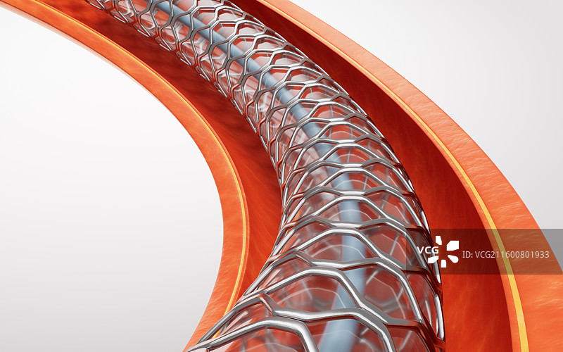 血管中的冠状动脉支架三维渲染图片素材