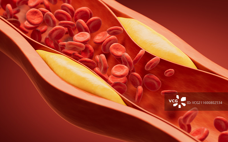 血管中的脂肪和血栓三维渲染图片素材