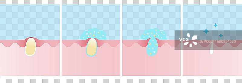 痤疮粉刺治疗过程的步骤图片素材