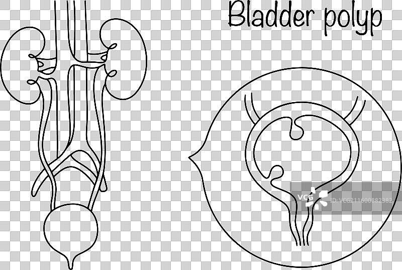 膀胱息肉图片素材