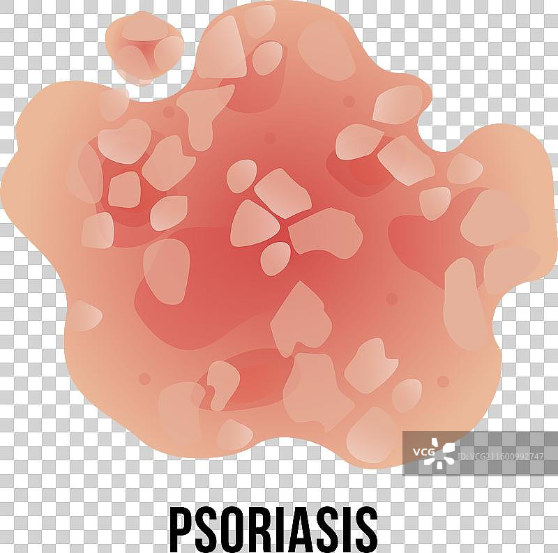 牛皮癣皮肤病灶的特写图片素材