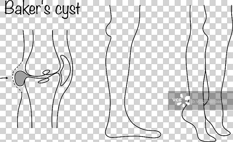 腘窝囊肿图片素材