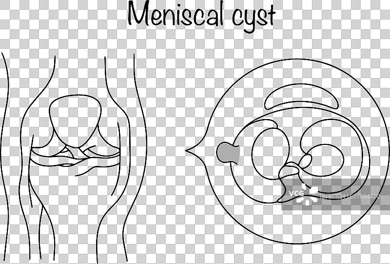 半月板囊肿图片素材