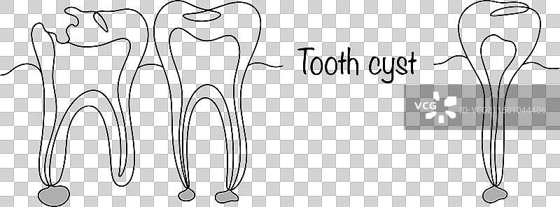 牙囊肿图片素材