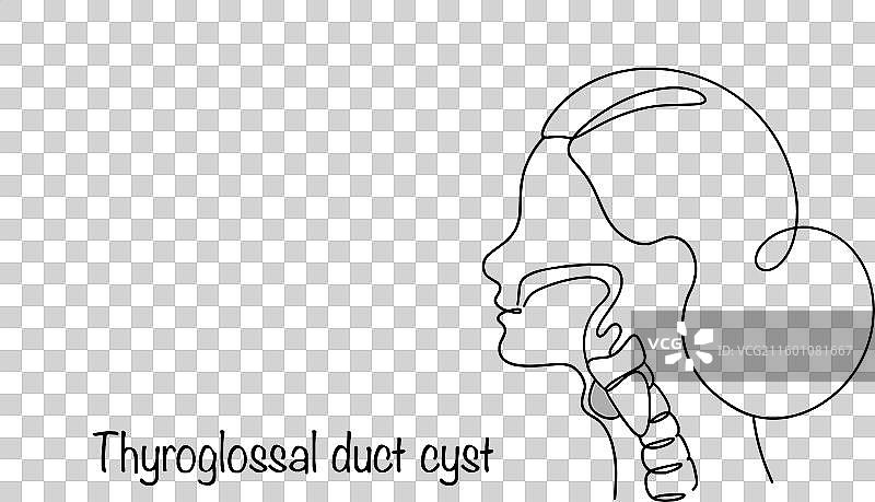 舌骨舌管囊肿图片素材