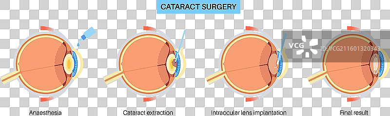 白内障手术海报图片素材