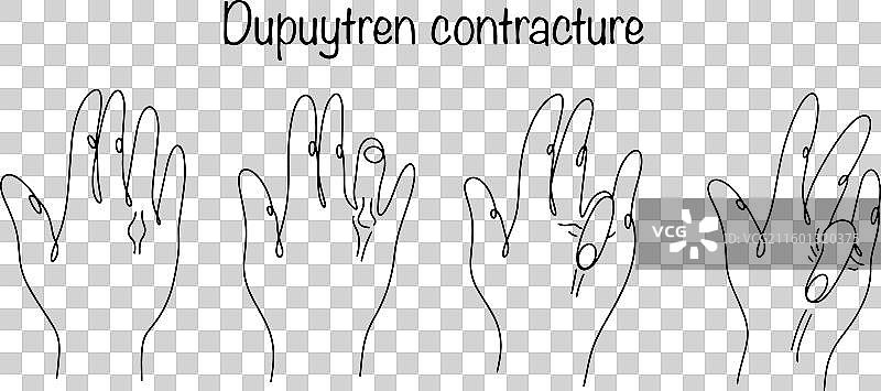 迪皮特朗攣縮图片素材