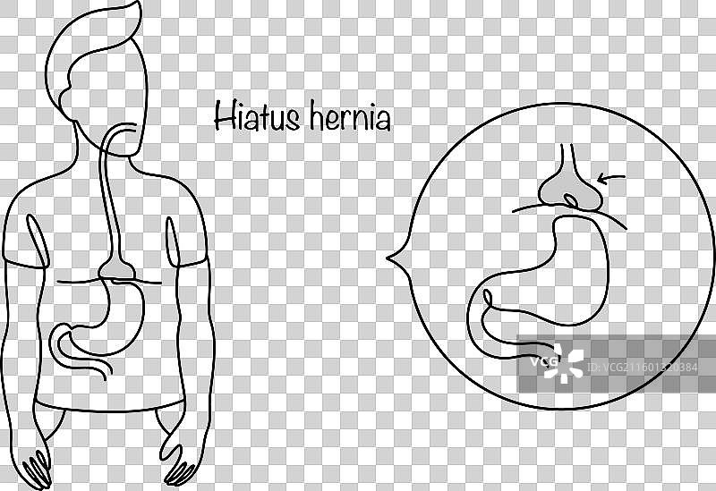 食管裂孔疝图片素材