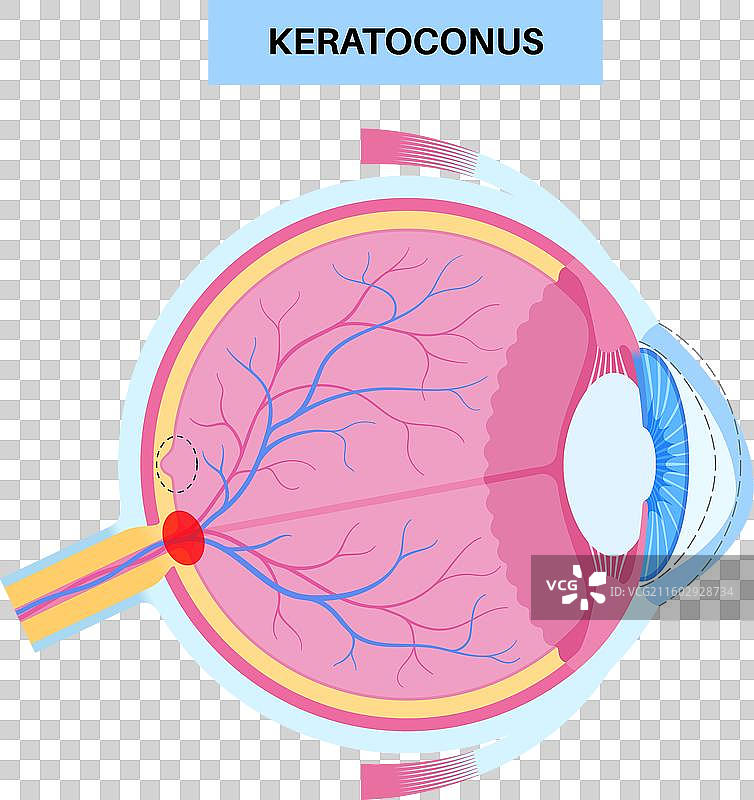 白内障眼疾图片素材