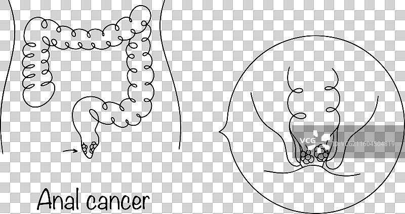 肛门癌图片素材