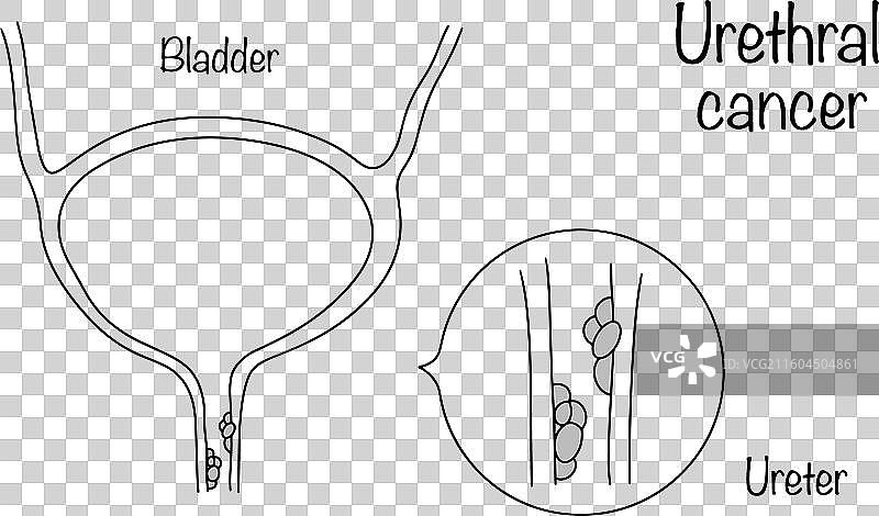 尿道癌图片素材