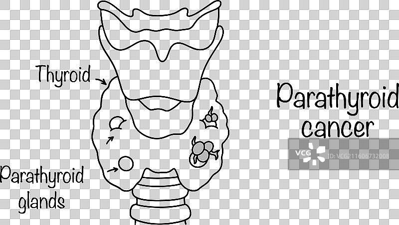 甲状旁腺癌图片素材