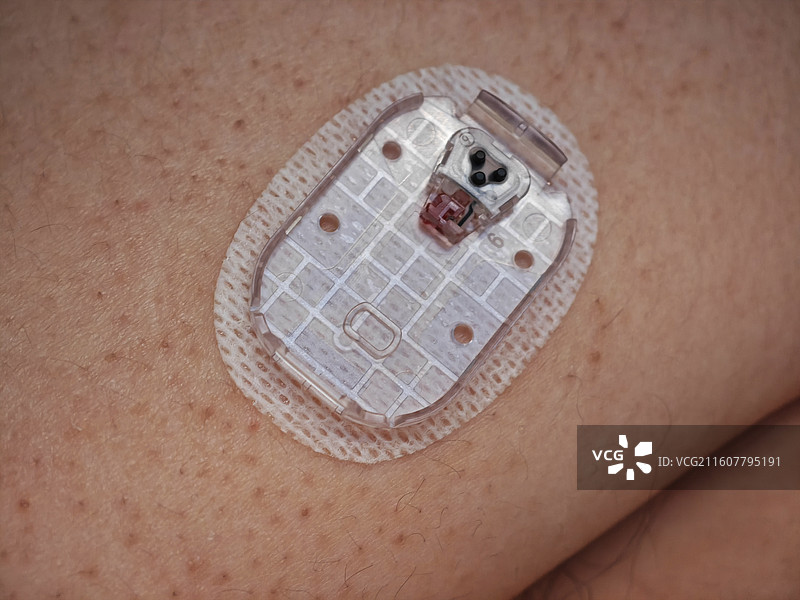 佩戴分体式动态血糖仪 将柔性探针置入手臂上臂通过蓝牙技术持续监测血糖水平 硅基动态 国产医疗器械图片素材