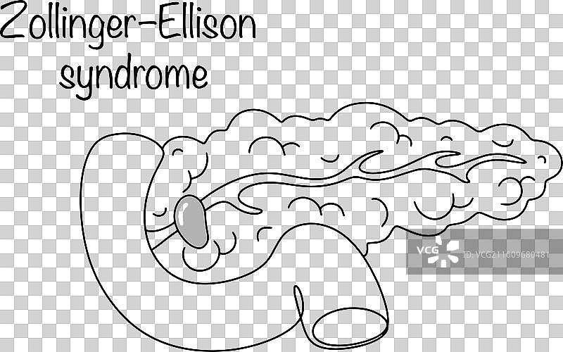 卓-艾氏综合征图片素材