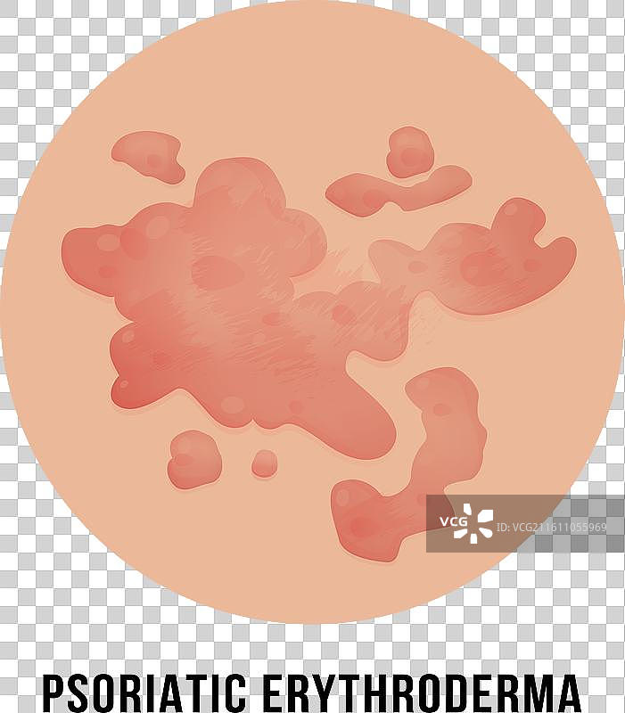 大片红色斑块状银屑病性红皮病图片素材