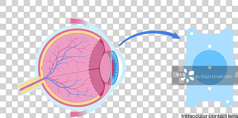 EVO ICL 海报图片素材