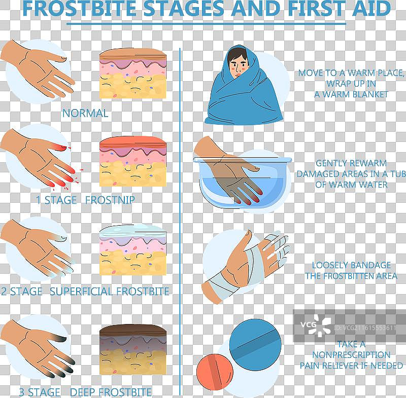 冻伤信息图：急救与分期图片素材