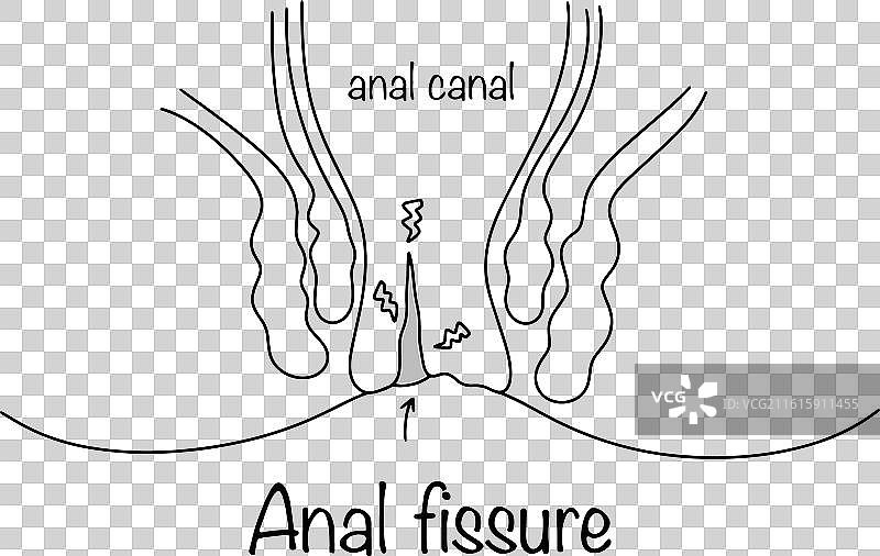 肛裂图片素材