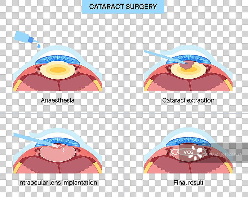 白内障手术海报图片素材